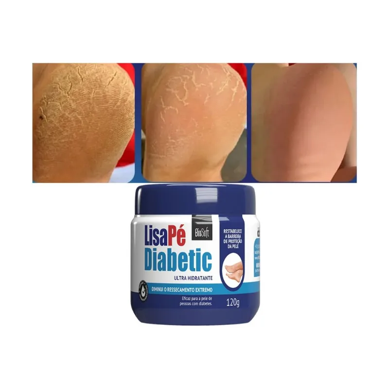 Produto Hidratante Pés Diabéticos Ressecados Com Rachaduras